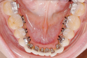innenliegende Zahnspange - Unterkiefer